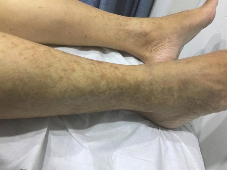 患者的双小腿内外侧皮肤上呈片状散在分布着深褐色色素沉着斑,无高出